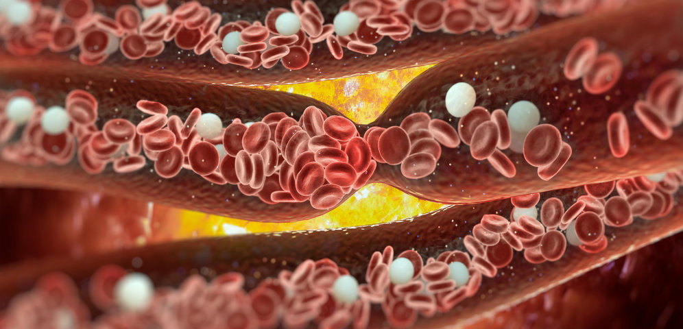 Ateroskleróza - onemocnění cév
